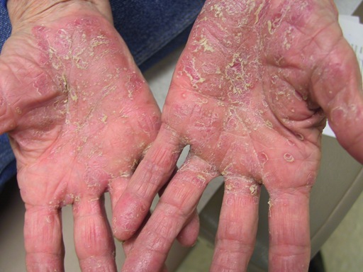 Psoriasis types: Pustular | National Psoriasis Foundation