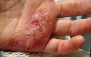 Dyshidrosis: Causes, symptoms and natural remedies image-632
