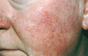 Rosacea: effect of cold symptoms in the skin image-612