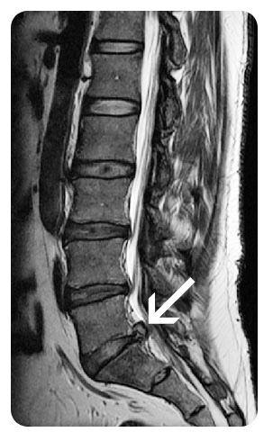 little disc herniated