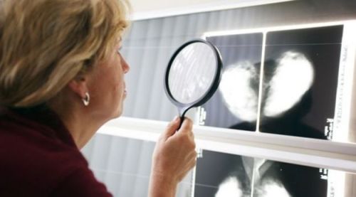 breast cancer diagnosis
