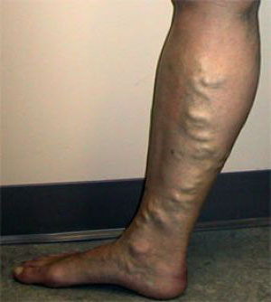 varicose veins