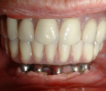 dental implant