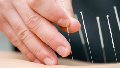 acupuncture