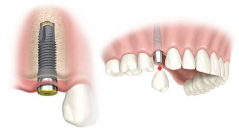 dental implants