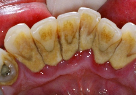 periodontitis