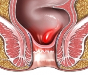 hemorrhoids