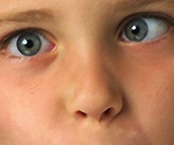 strabismus