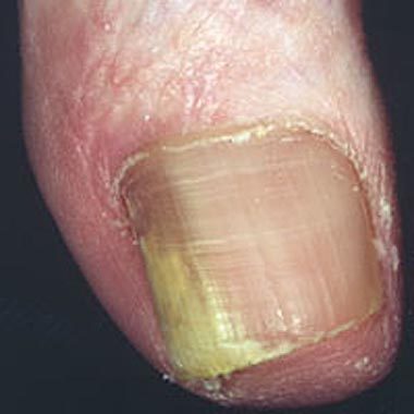 onychomycosis