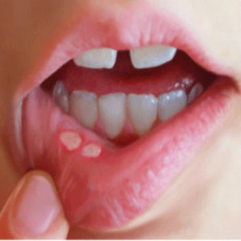 mouth ulcer