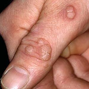 warts