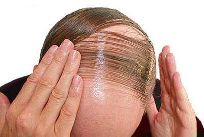 hair loss problem