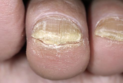 Yellow toenails and fluted nails: The best remedies â€“ From Doctor