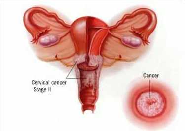 cervical cancer