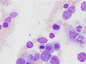 myelodysplastic syndromes