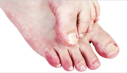 chilblains