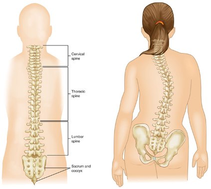 scoliosis