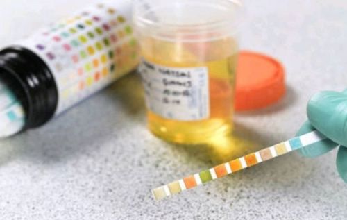color of the urine