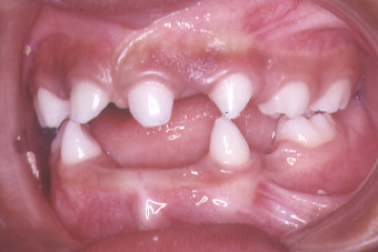 ectodermal dysplasia