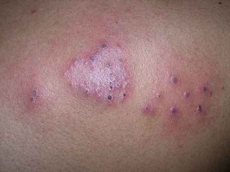 skin ulcers