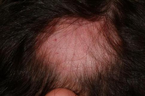 alopecia areata