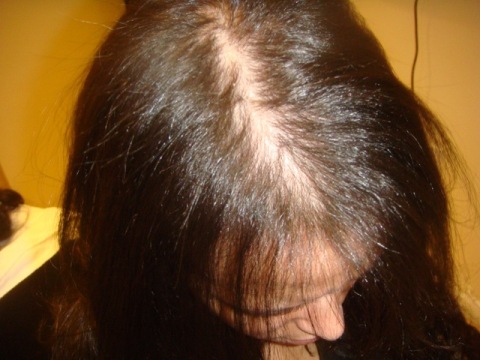 androgenic alopecia in women