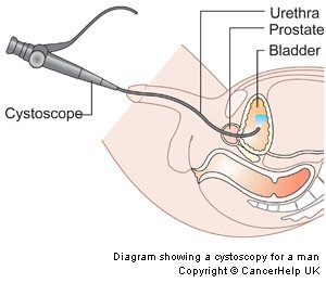 cystoscopy