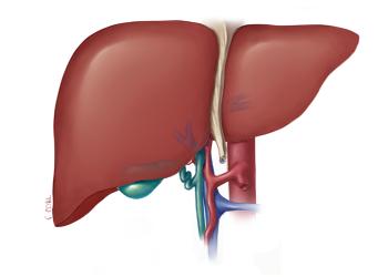 gilbert syndrome