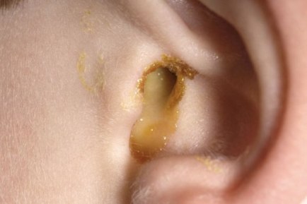 Swimmer's ear