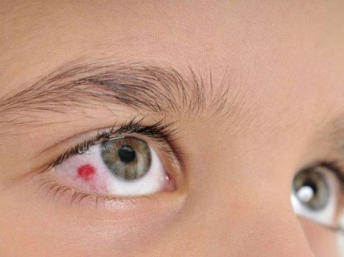 blood-in-the-eye-what-to-do-causes-and-remedies-from-doctor