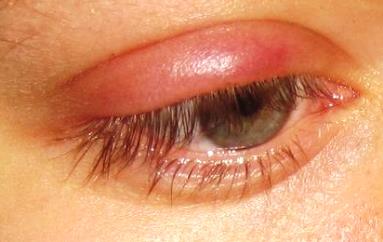 symptoms of stye