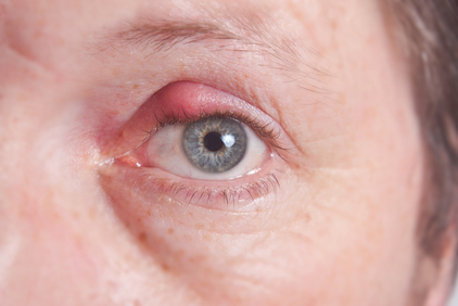 chalazion in the eye