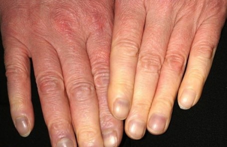 raynaud's phenomenon