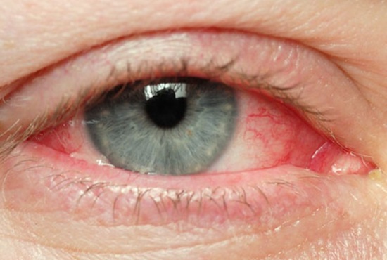 orbital cellulitis symptoms