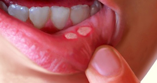 remedies for mouth sores