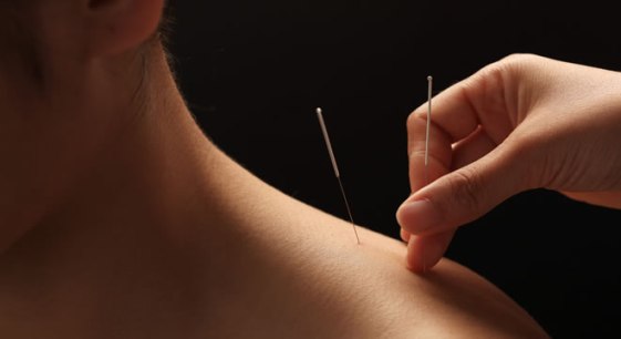 acupuncture technique