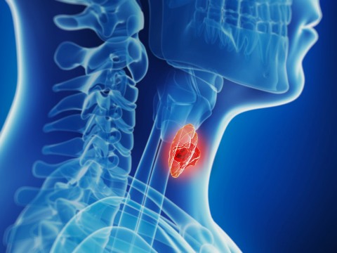 thyroid cancer