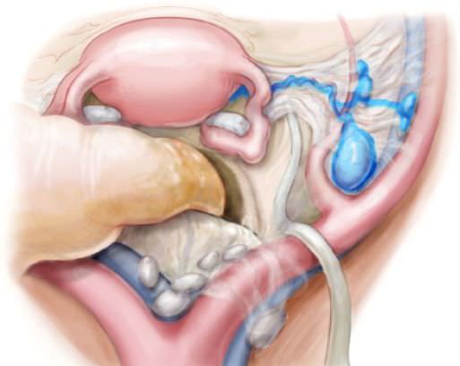 sentinel lymph node