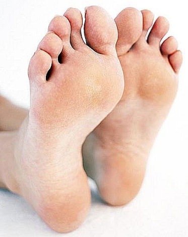 diabetic foot