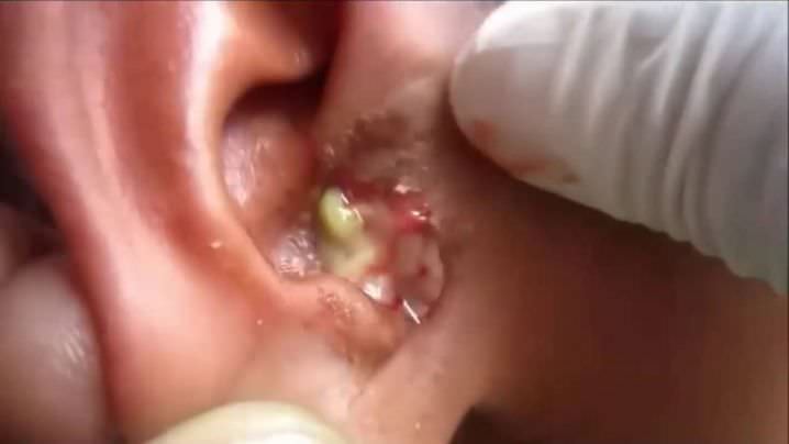 fungal ear infection