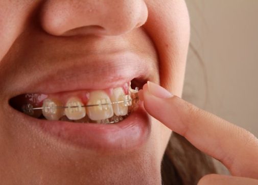 using dental brackets