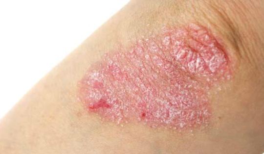 eczema on the skin