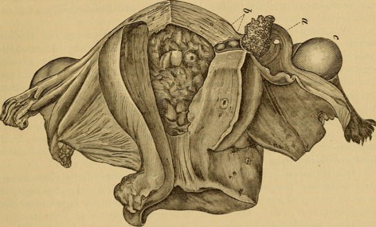 uterine polyp