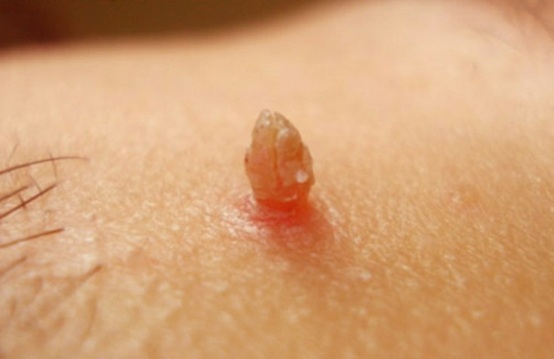 remove warts