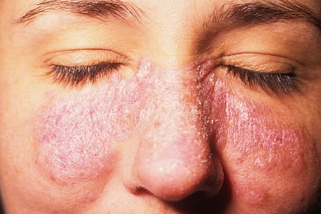 systemic lupus erythematosus