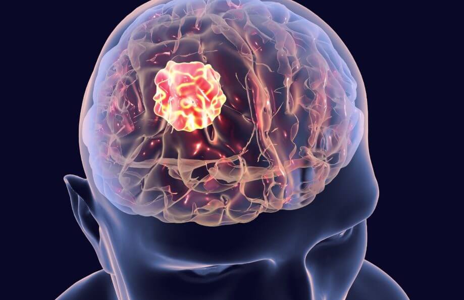 diagnostic of glioblastoma