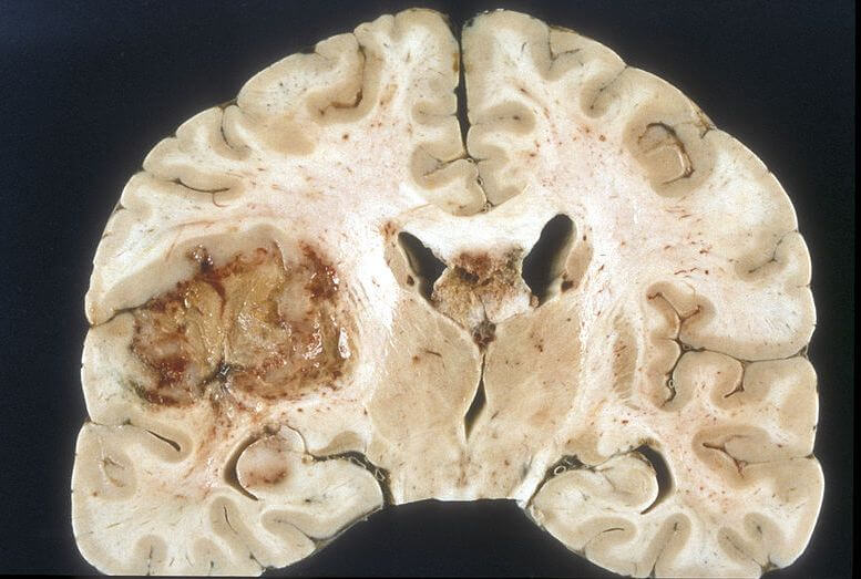 brain tumour