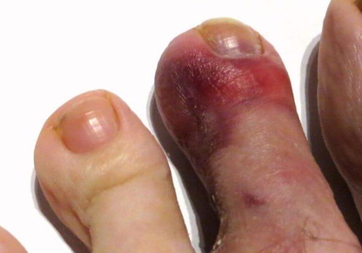 purple-toe-causes-and-treatment-from-doctor