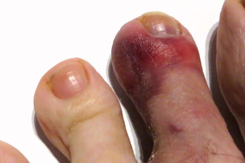 purple-toe-causes-and-treatment-from-doctor