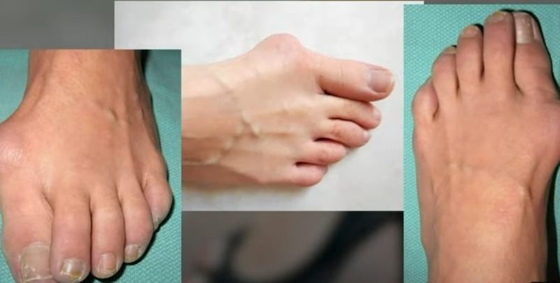 Cured Bunions Naturally